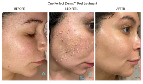 Perfect Derma Peel (in person or virtually)