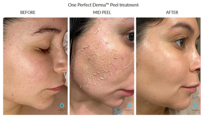 Perfect Derma Peel (in person or virtually)