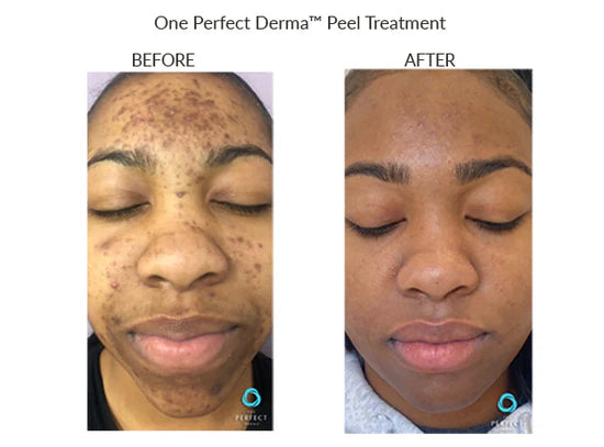 Perfect Derma Peel (in person or virtually)